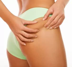 Come prevenire la cellulite