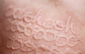 dermatografia (4)