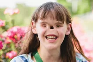 Cassidy Hooper: la bambina nata senza naso e occhi