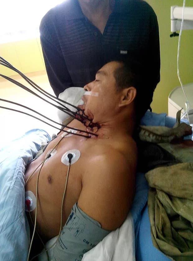 Cina, colpito da 7 barre di metallo sul collo, sopravvive [FOTO]