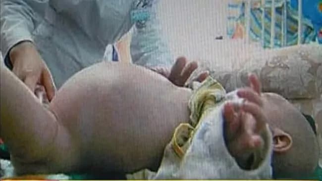 Bambino di due anni partorisce il suo gemellino