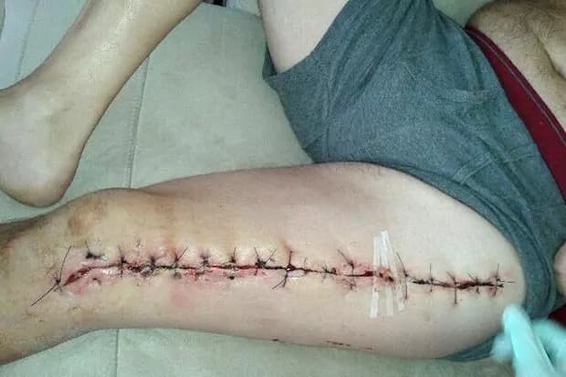 Gran Bretagna, per il morso di un ragno gli aprono in due la gamba
