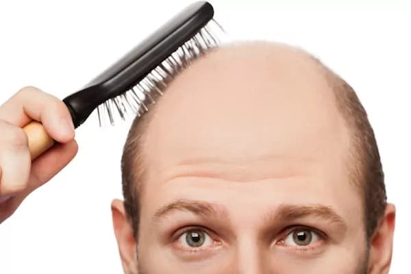 Pipì per combattere la calvizie
