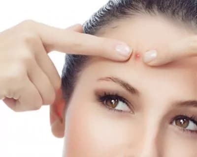 Acne: cause e rimedi naturali per dire addio a brufoli e punti neri