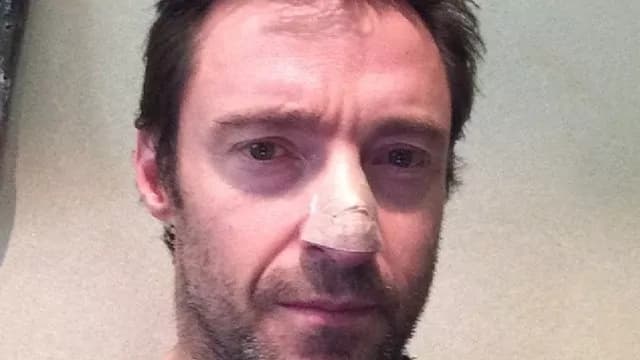 Hugh Jackman operato di tumore maligno alla pelle