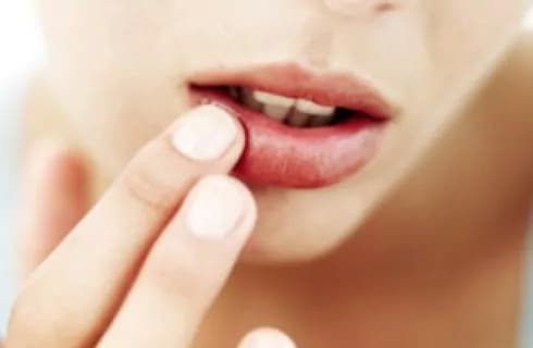 Herpes labiale: cause e rimedi naturali per attenuarne i sintomi e bloccarne lo sviluppo