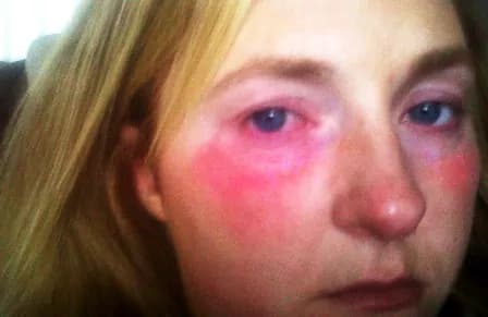 Katie: la ragazza che non può piangere perchè allergica all’acqua