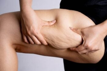 Come distinguere il lipedema dalla cellulite